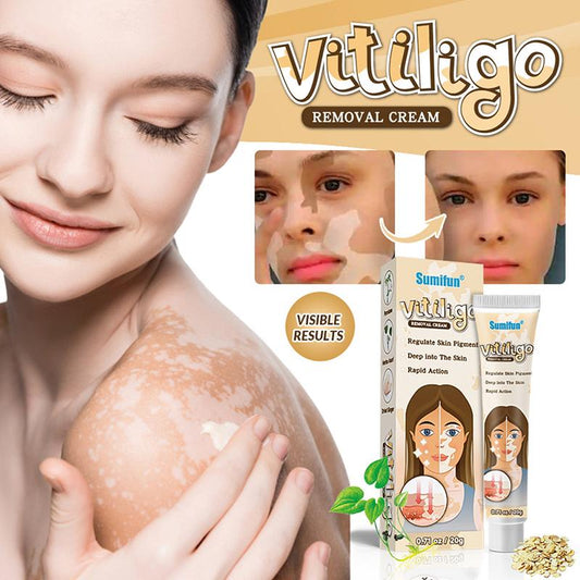 Treatment Moisturizing Cream White Spot Disease Vitiligo Balm Repair Ointment
